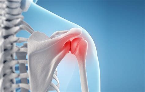 Простые способы снятия боли при артрите плечевого сустава